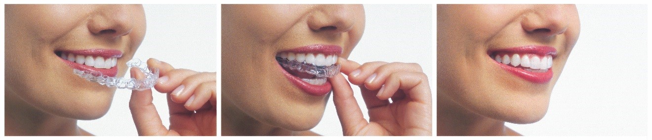 Orthodontie Invisalign