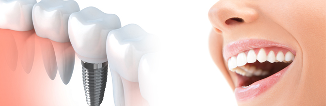 dental implants maintenance