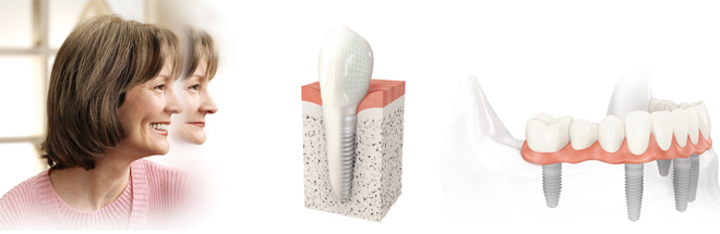 dental implants